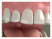 Dental implant step 3